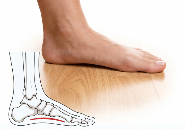 Flat Foot